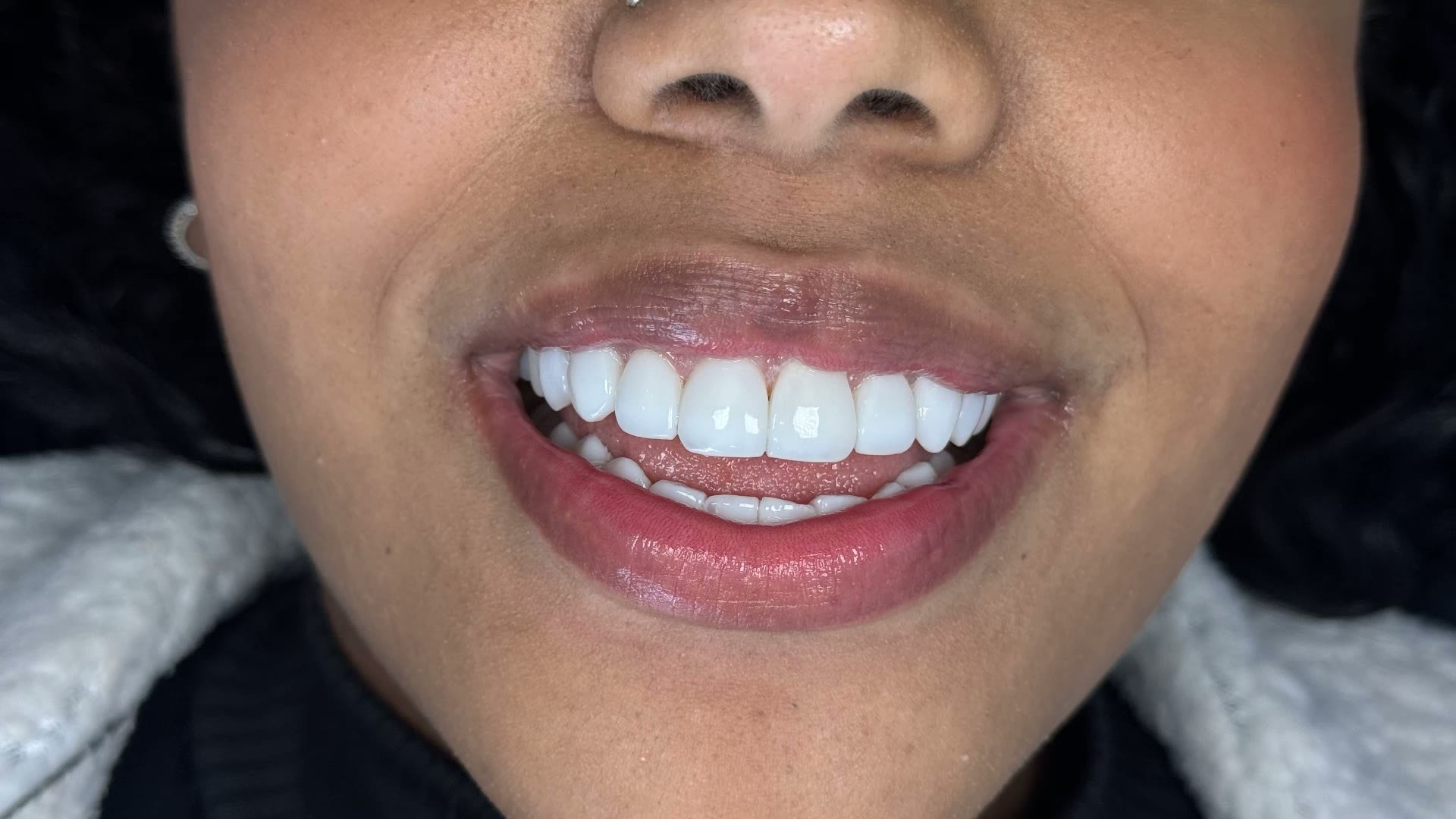 Close de sorriso finalizado com resina composta