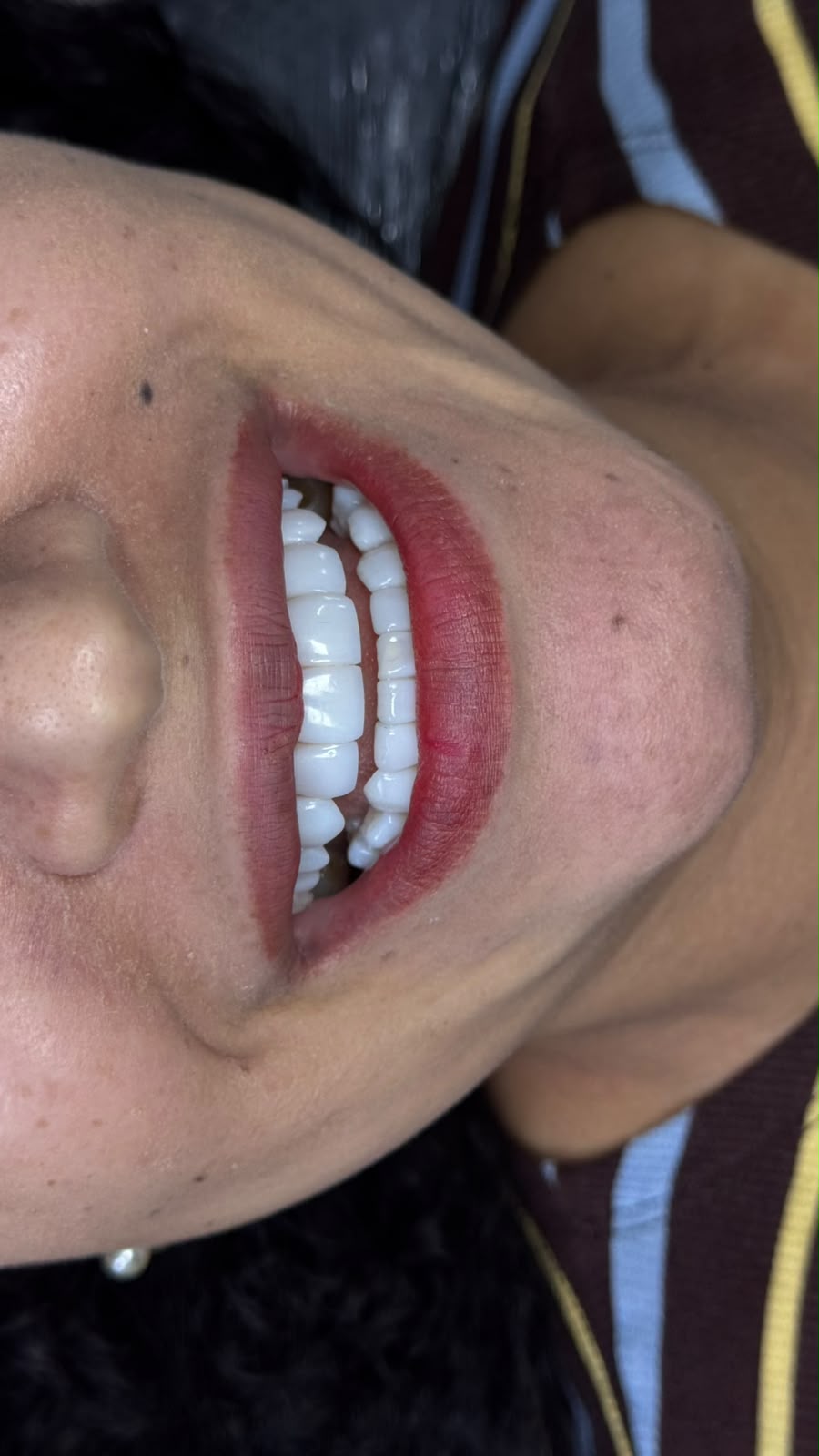 Antes e depois de lentes em resina