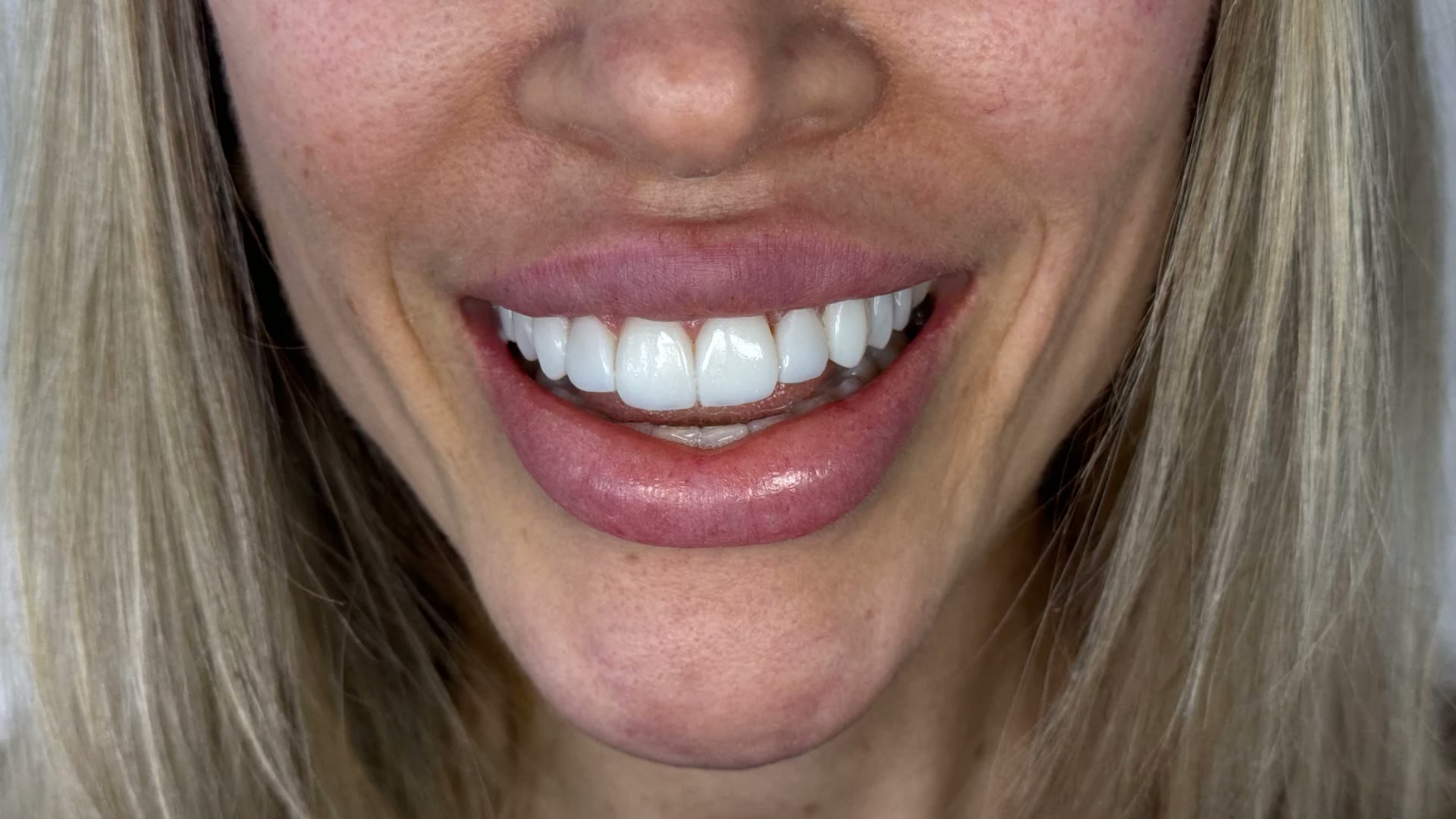 Sorriso feminino em close após lentes de resina
