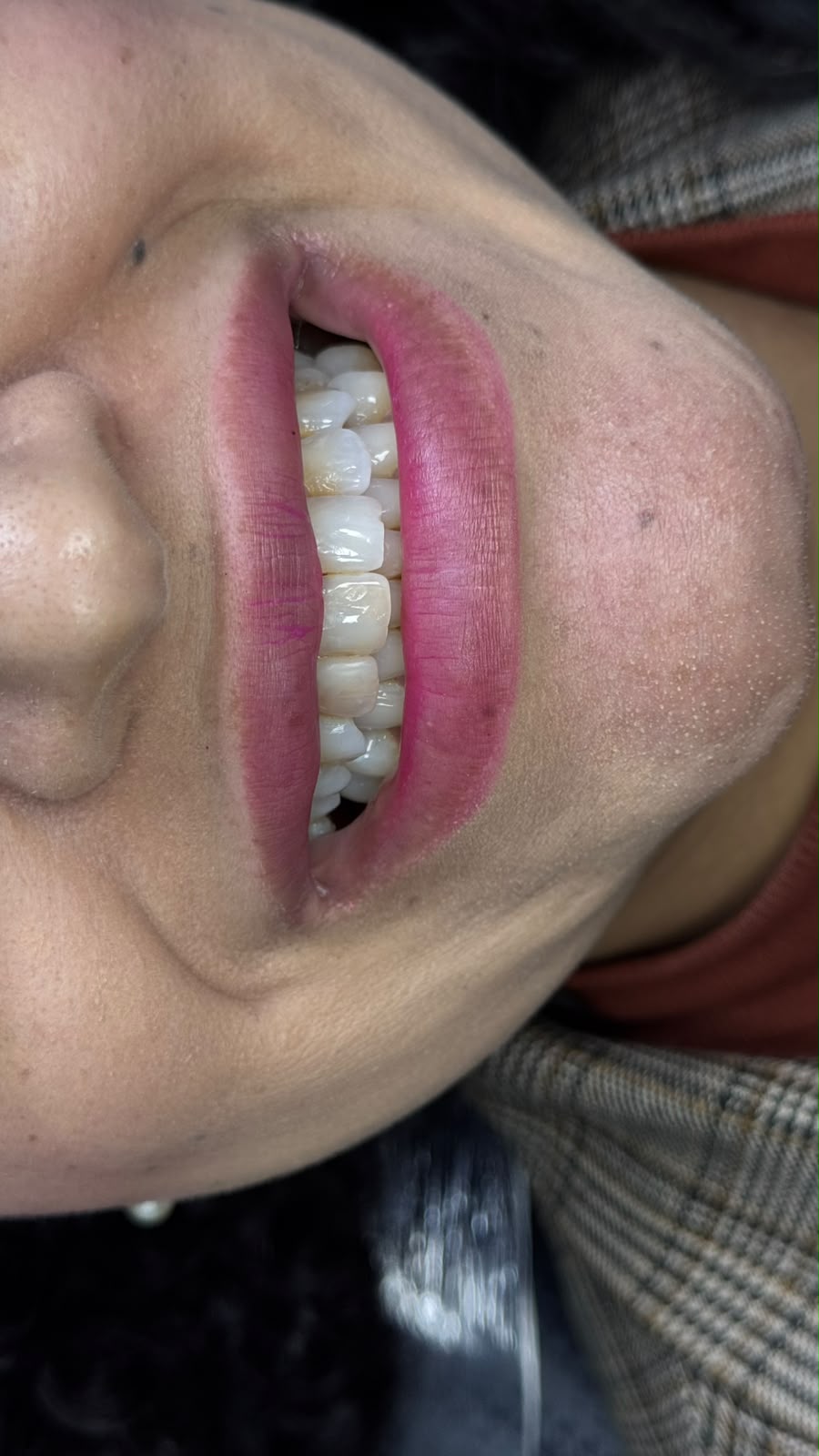 Antes e depois de lentes em resina
